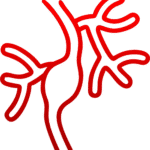 Aneurisma<br>de Aorta